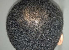 Load image into Gallery viewer, Dry Hair Loss Prevention Complete System