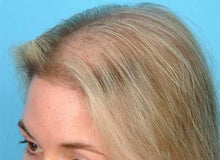 Load image into Gallery viewer, Normal Hair Loss Prevention Complete System