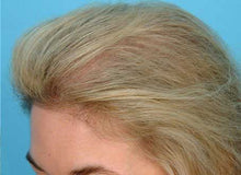 Load image into Gallery viewer, Normal Hair Loss Prevention Complete System