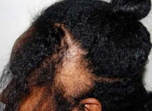 Load image into Gallery viewer, Dry Hair Loss Prevention Complete System