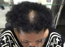 Load image into Gallery viewer, Dry Hair Loss Prevention Complete System
