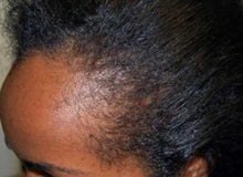 Load image into Gallery viewer, Dry Hair Loss Prevention Complete System
